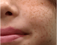 Tipos de manchas piel y como eliminarlas - blog farmacia 24h - Farmacia 24 horas Palma | Farmacia Balanguera