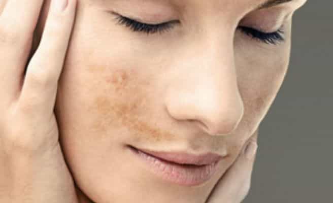 Tipos de manchas piel y como eliminarlas - blog farmacia 24h - Farmacia 24 horas Palma | Farmacia Balanguera